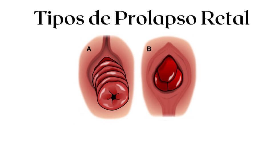 Tipos e Tratamento do Prolapso Retal