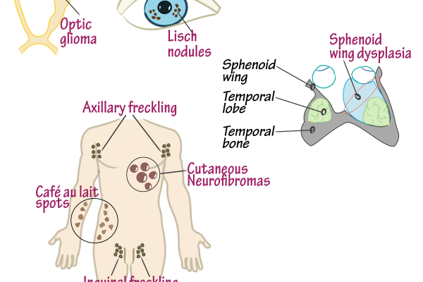 Neurofibromatose tipo 1: Entenda os sintomas e tratamento das neurofibromatoses